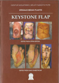 Image of Keystone flap / Gentur Sudjatmiko., dkk.