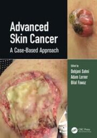 Advanced skin cancer : a case-based approach