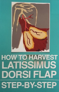 How to harvest latissimus dorsi flap; step-by-step / Parintosa Atmodiwirjo., dkk.